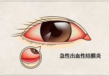 急性出血性结膜炎（红眼病），我们应该注意什么？