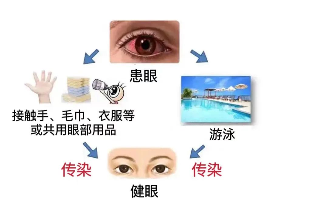 红眼病1.jpg 红眼病1.jpg