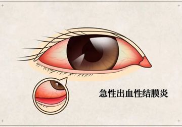 急性出血性结膜炎（红眼病），我们应该注意什么？