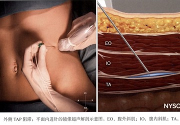 剖宫产术后镇痛新技术（TAP）：告别疼痛噩梦