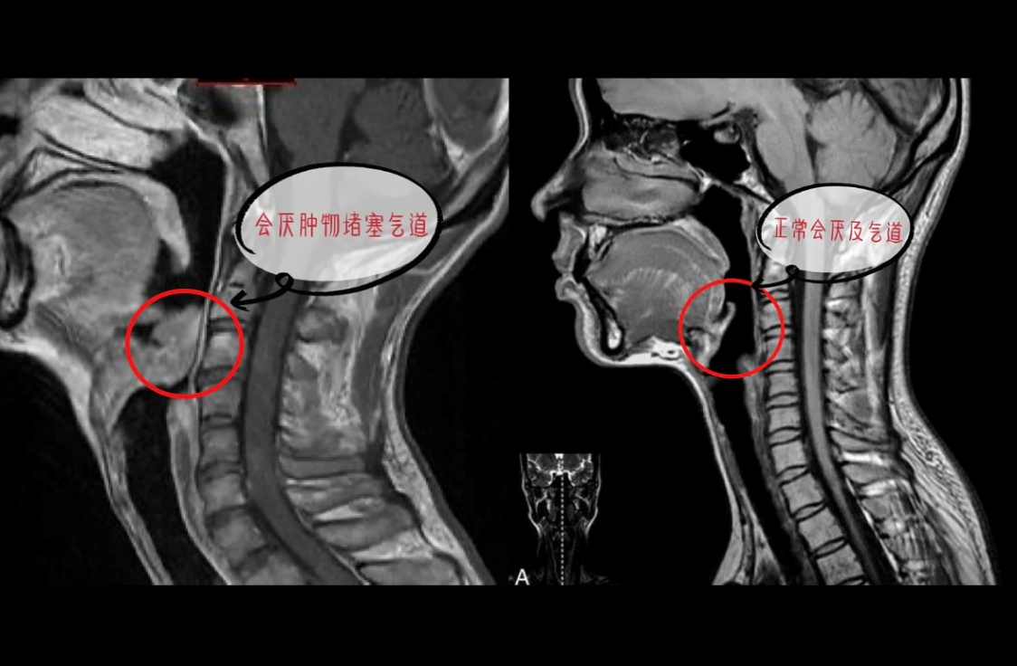 ▲ 左侧为患者颈部软组织MRI成像，右侧为正常颈部软组织成像